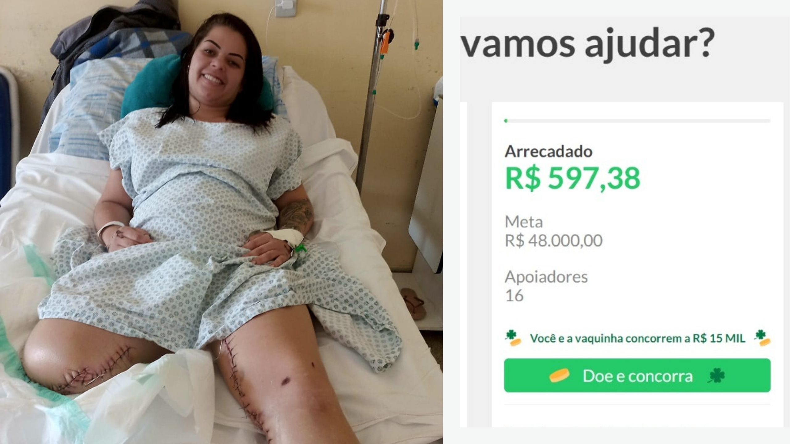 Moradora De S O Roque Tem Perna Amputada Em Acidente E Fam Lia Faz Vaquinha Para Comprar Pr Tese